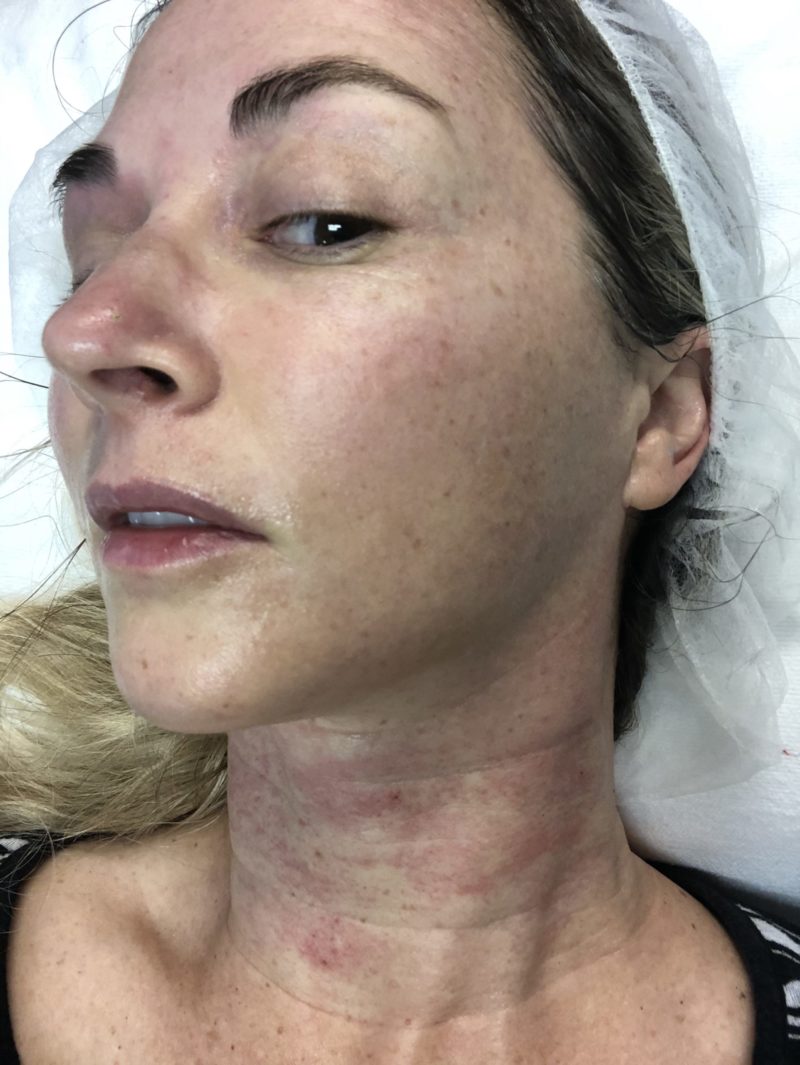 Dr. Grell's Halo Laser Treatment Experience Hellerstein & Brenner